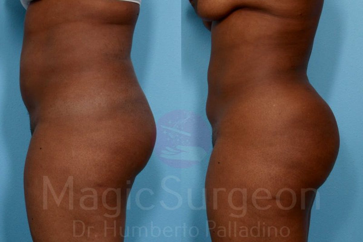 Liposuction Before & After Gallery - Patient 133182306 - Image 4