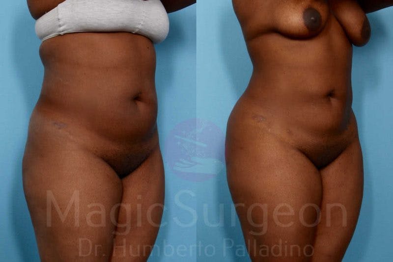 Liposuction Before & After Gallery - Patient 133182306 - Image 4