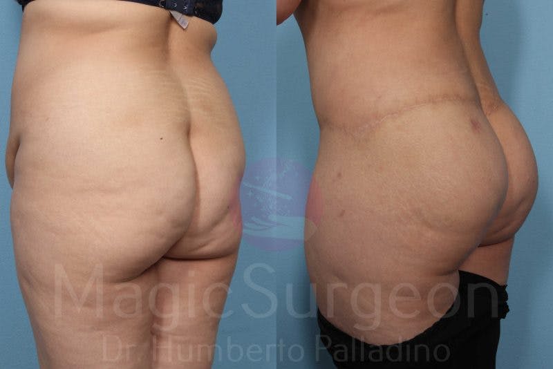 Brazilian Butt Lift Before & After Gallery - Patient 143542653 - Image 5