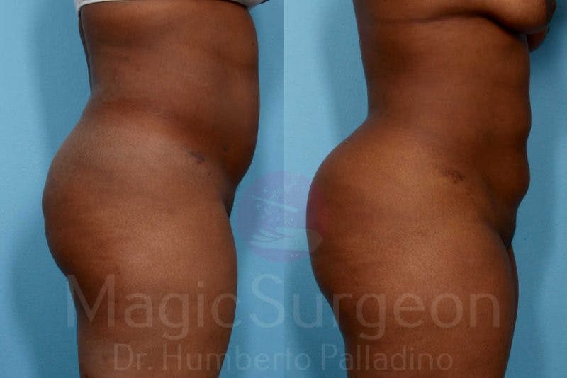 Liposuction Before & After Gallery - Patient 133182306 - Image 5