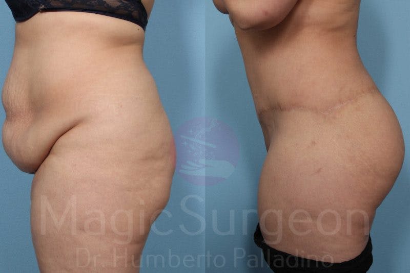 Brazilian Butt Lift Before & After Gallery - Patient 143542653 - Image 4