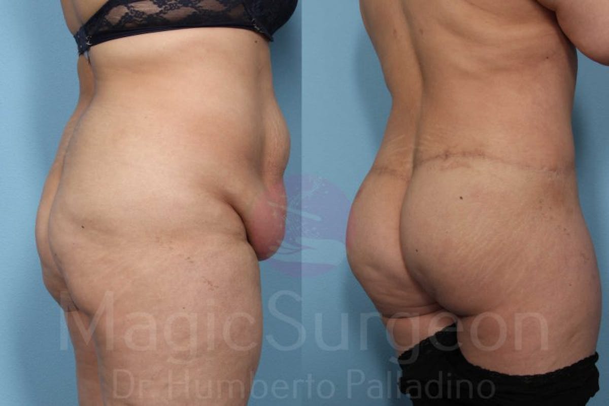 Brazilian Butt Lift Before & After Gallery - Patient 143542653 - Image 3