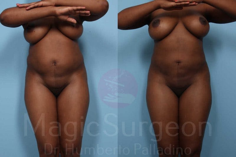 Liposuction Before & After Gallery - Patient 133182310 - Image 1