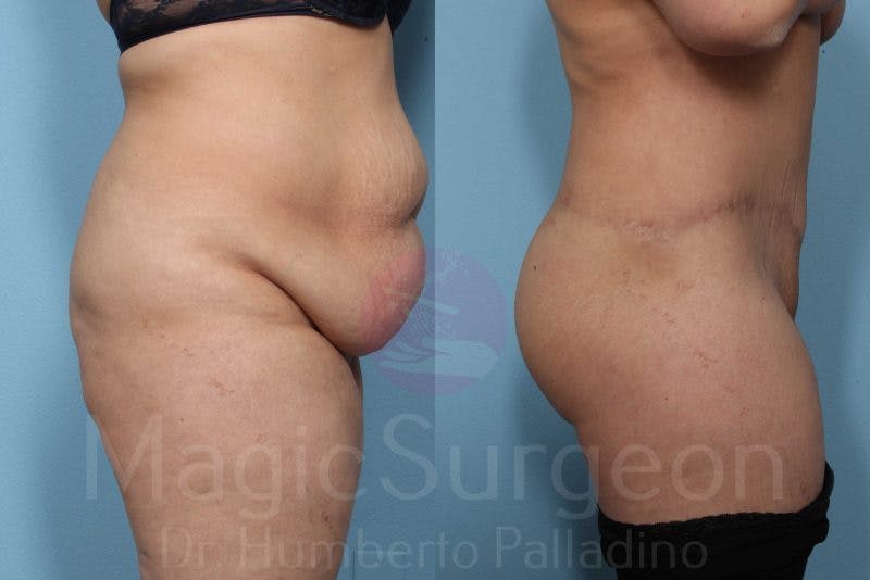 Brazilian Butt Lift Before & After Gallery - Patient 143542653 - Image 2