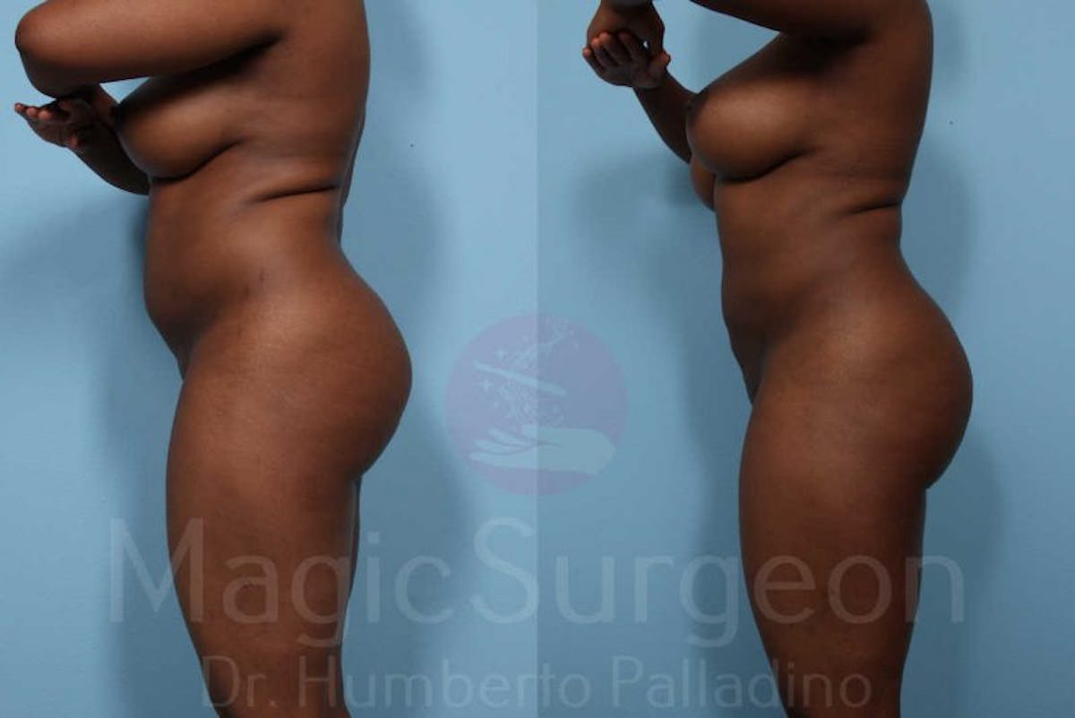 Liposuction Before & After Gallery - Patient 133182310 - Image 3