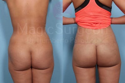 Brazilian Butt Lift Before & After Gallery - Patient 143542798 - Image 1