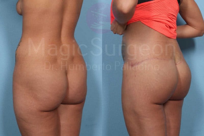 Brazilian Butt Lift Before & After Gallery - Patient 143542798 - Image 3