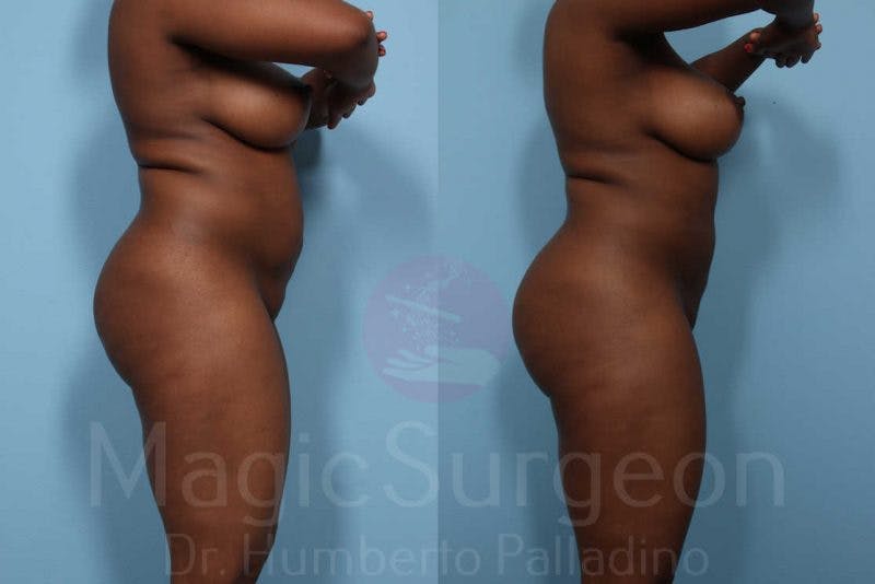 Liposuction Before & After Gallery - Patient 133182310 - Image 5