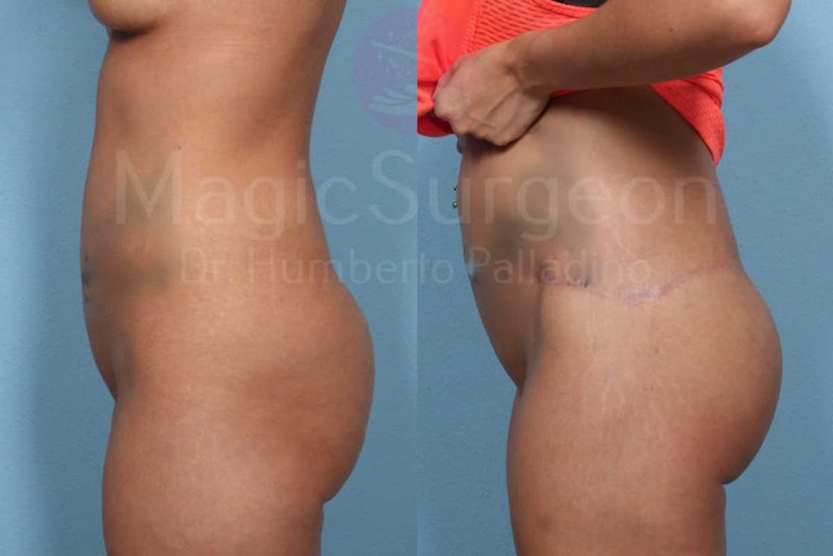 Brazilian Butt Lift Before & After Gallery - Patient 143542798 - Image 2