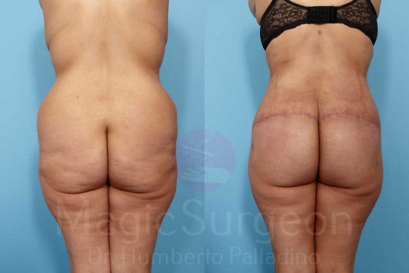 Brazilian Butt Lift Before & After Gallery - Patient 143542976 - Image 1