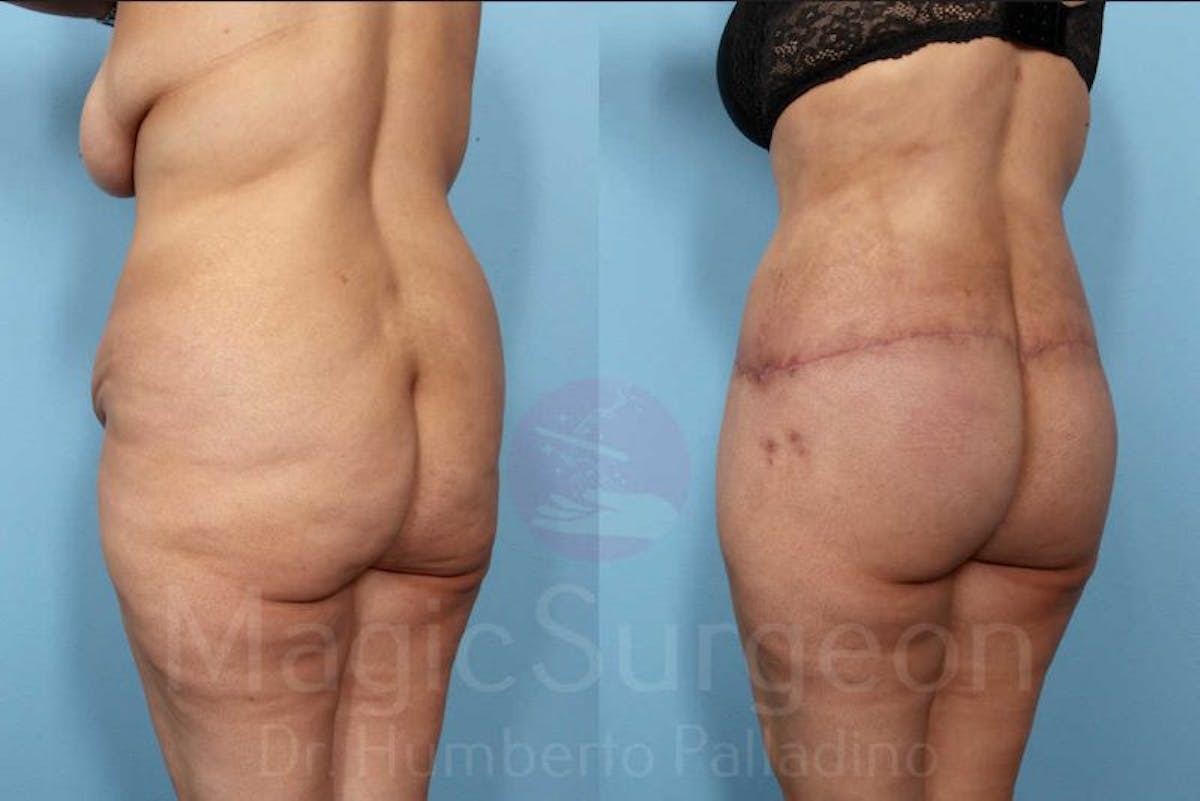 Brazilian Butt Lift Before & After Gallery - Patient 143542976 - Image 5