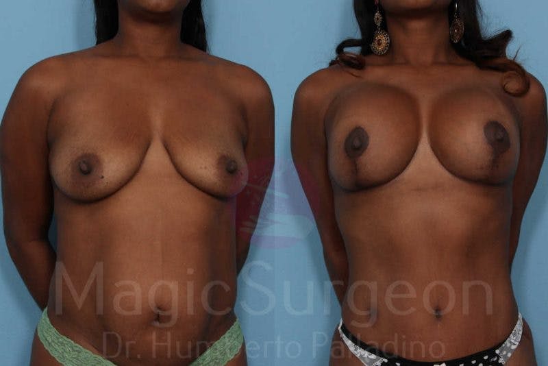 Mommy Makeover Before & After Gallery - Patient 133182311 - Image 1
