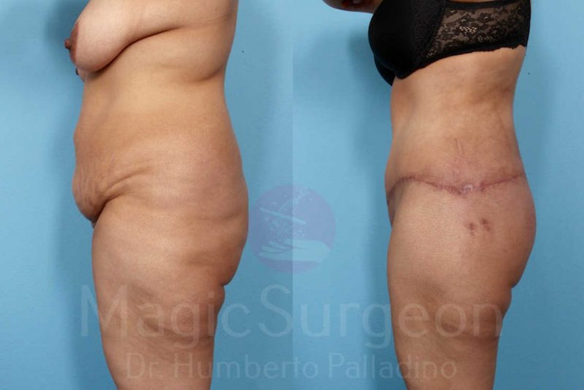 Brazilian Butt Lift Before & After Gallery - Patient 143542976 - Image 4