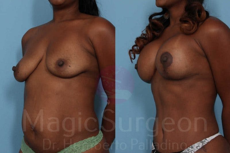 Mommy Makeover Before & After Gallery - Patient 133182311 - Image 2