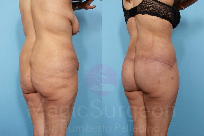 Brazilian Butt Lift Before & After Gallery - Patient 143542976 - Image 3