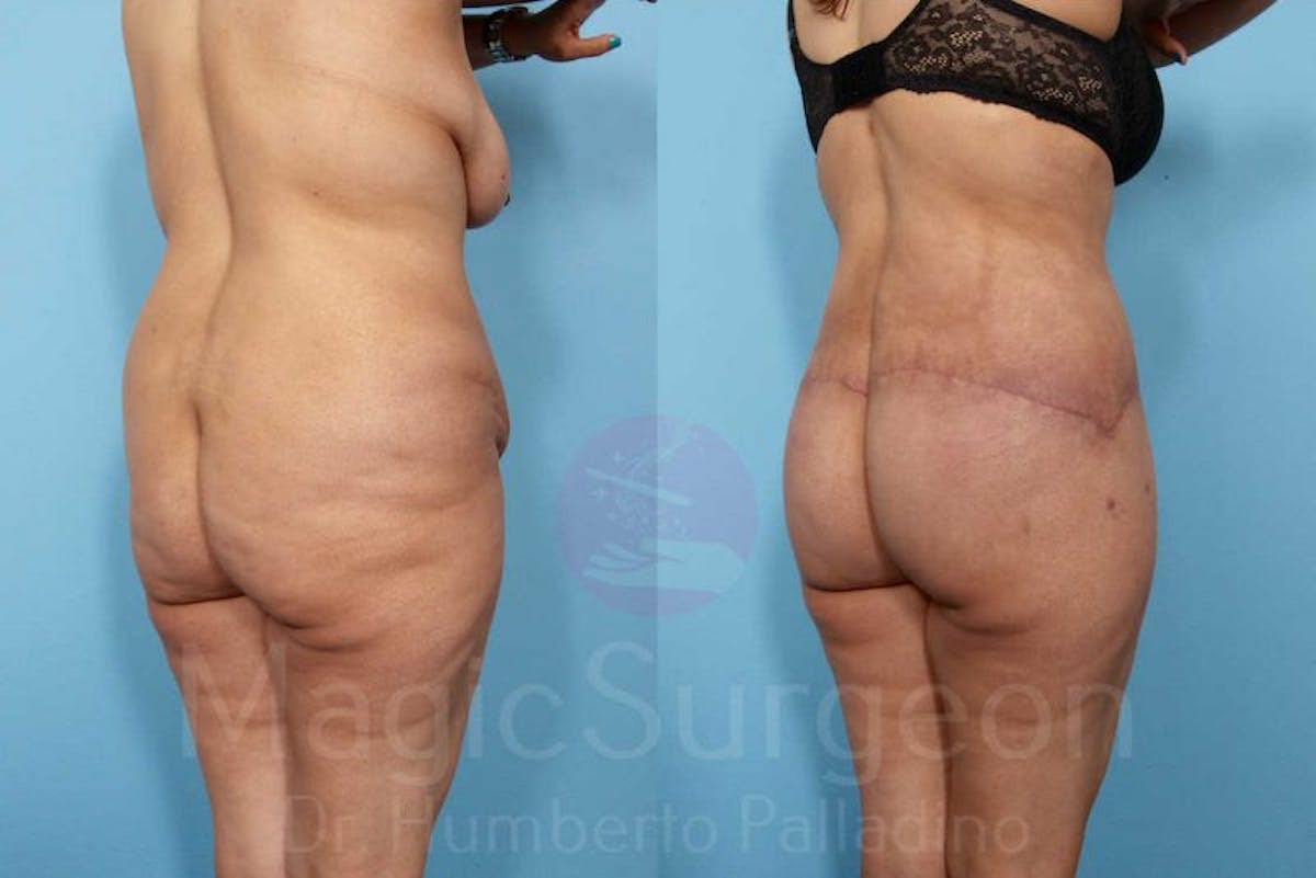 Brazilian Butt Lift Before & After Gallery - Patient 143542976 - Image 3