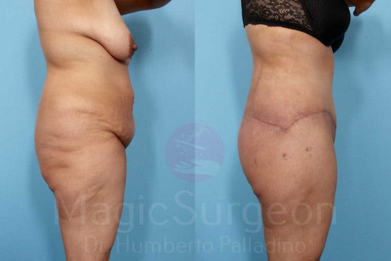 Brazilian Butt Lift Before & After Gallery - Patient 143542976 - Image 2