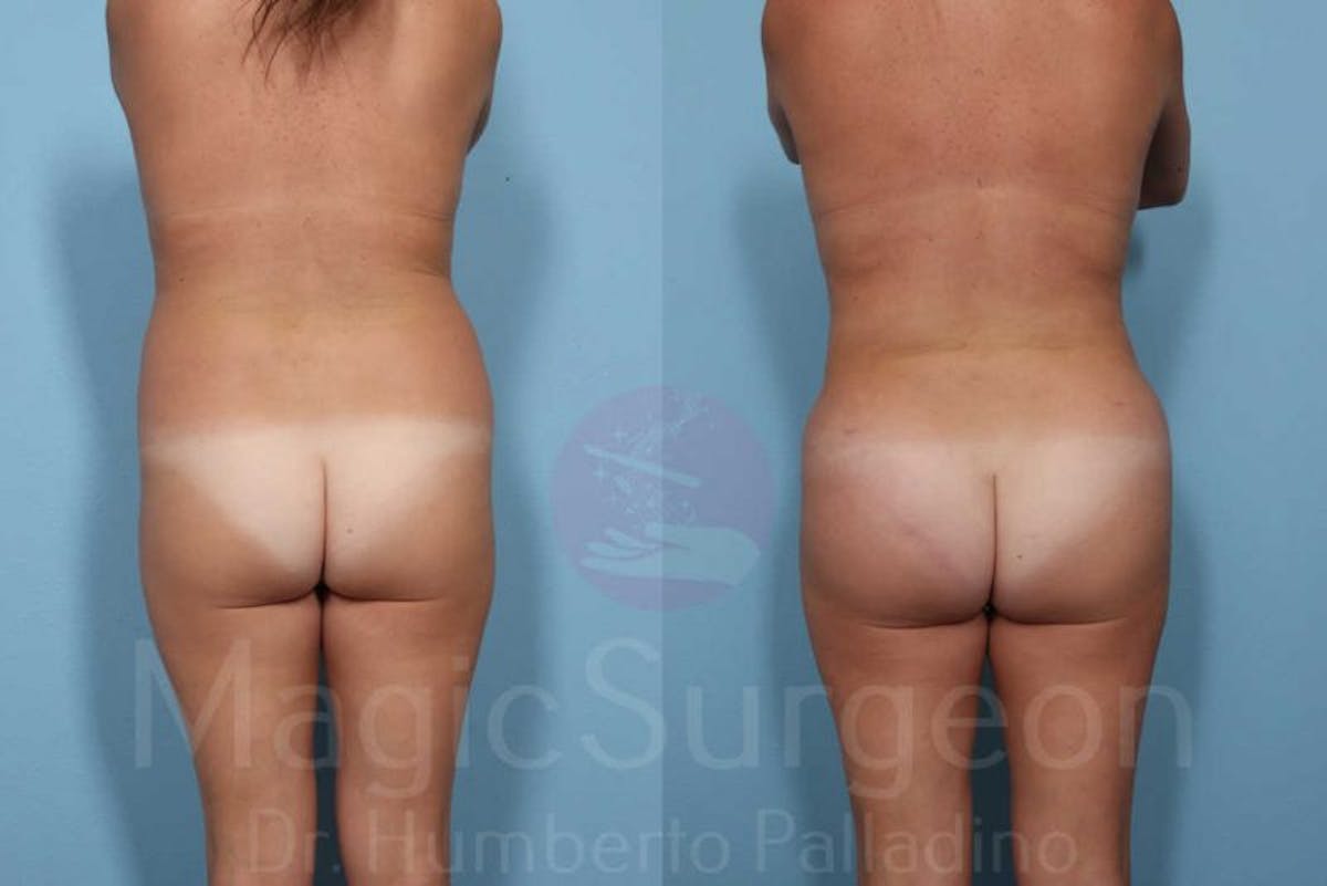 Liposuction Before & After Gallery - Patient 133182313 - Image 5