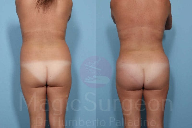 Liposuction Before & After Gallery - Patient 133182313 - Image 5