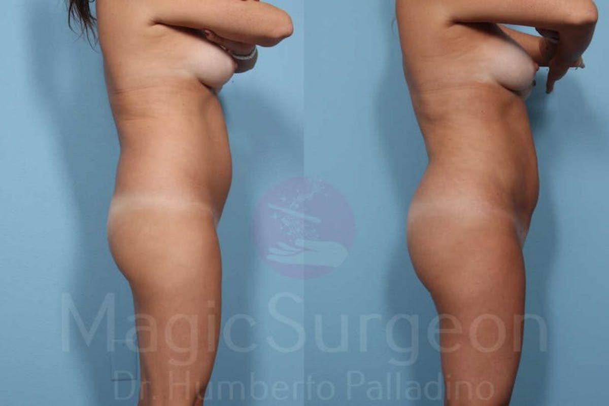 Liposuction Before & After Gallery - Patient 133182313 - Image 8