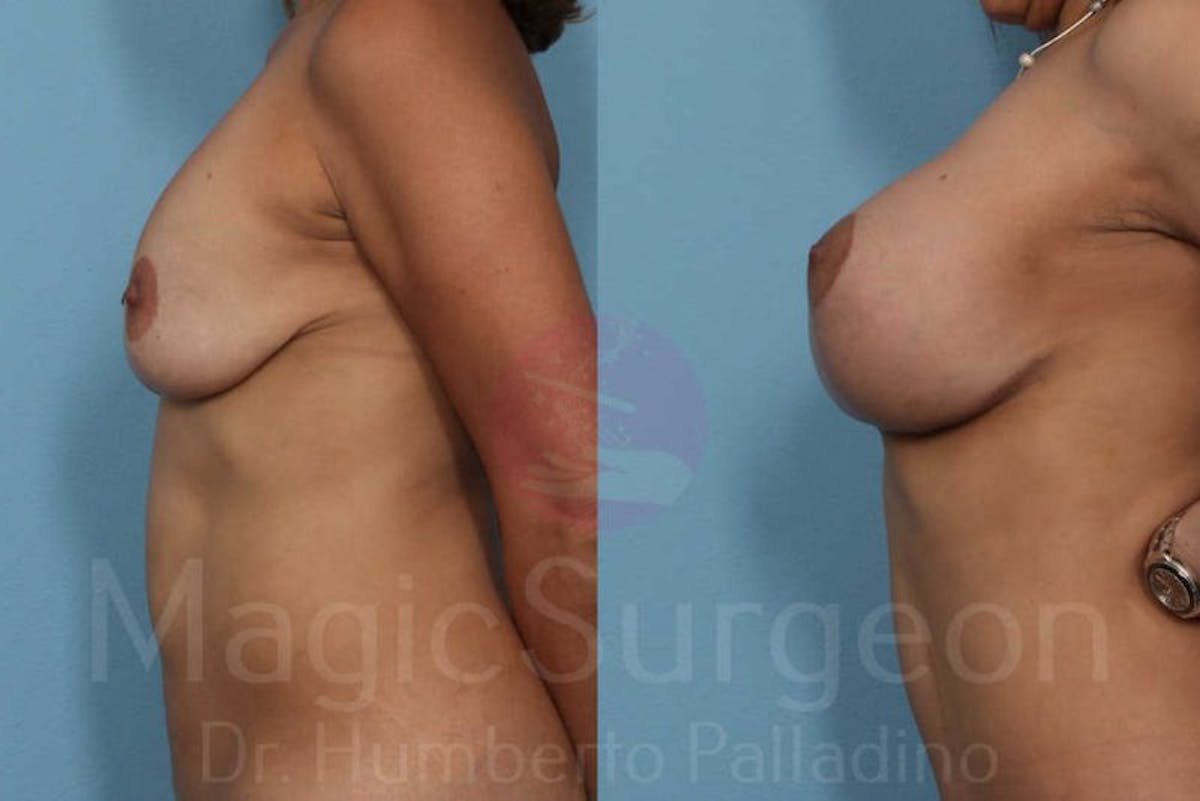Mommy Makeover Before & After Gallery - Patient 133182314 - Image 3