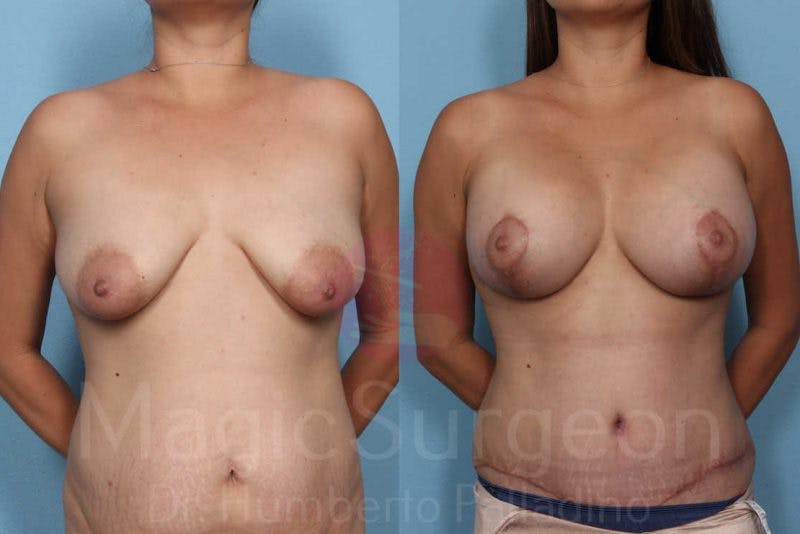 Mommy Makeover Before & After Gallery - Patient 133182317 - Image 1