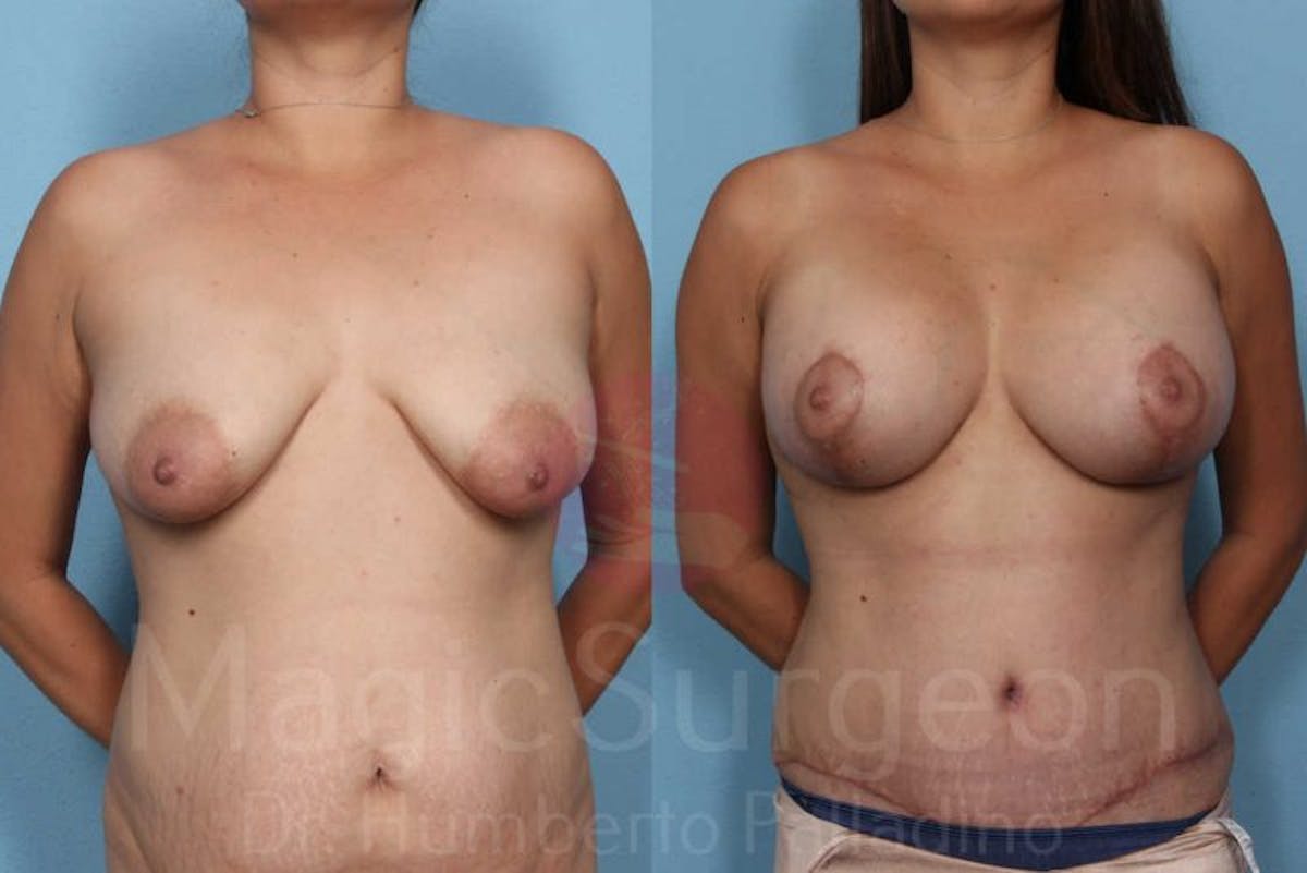 Mommy Makeover Before & After Gallery - Patient 133182317 - Image 1