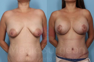 Mommy Makeover Before & After Gallery - Patient 133182317 - Image 1