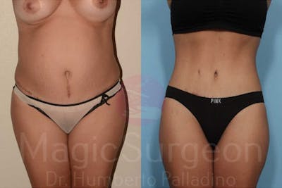 Tummy Tuck Before & After Gallery - Patient 133182316 - Image 1