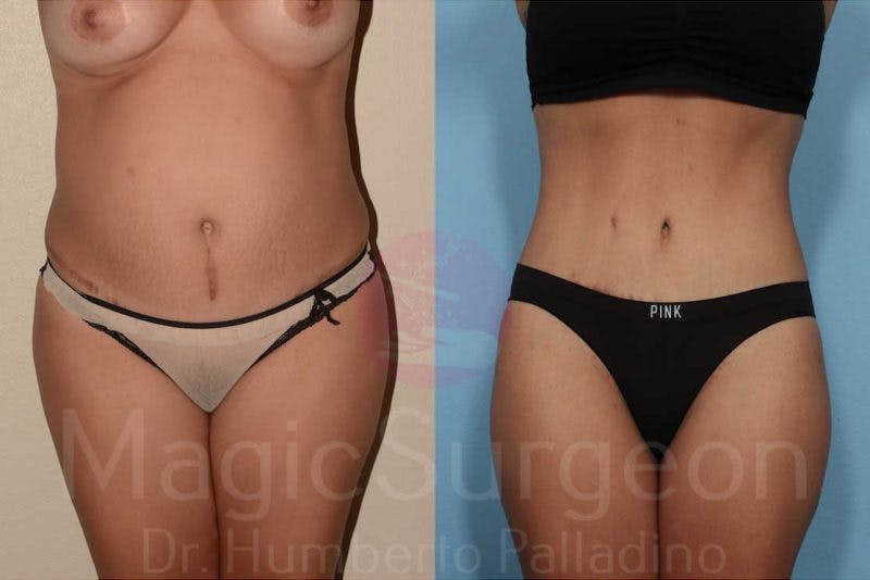 Tummy Tuck Before & After Gallery - Patient 133182316 - Image 1