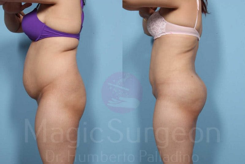 Liposuction Before & After Gallery - Patient 133182315 - Image 3