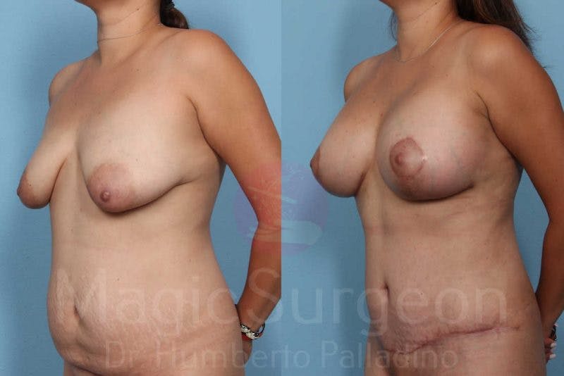 Mommy Makeover Before & After Gallery - Patient 133182317 - Image 2
