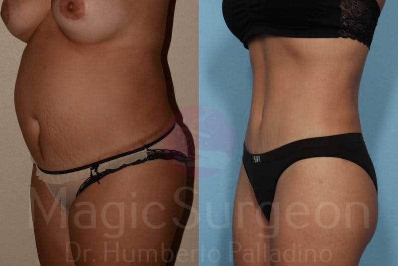 Tummy Tuck Before & After Gallery - Patient 133182316 - Image 2