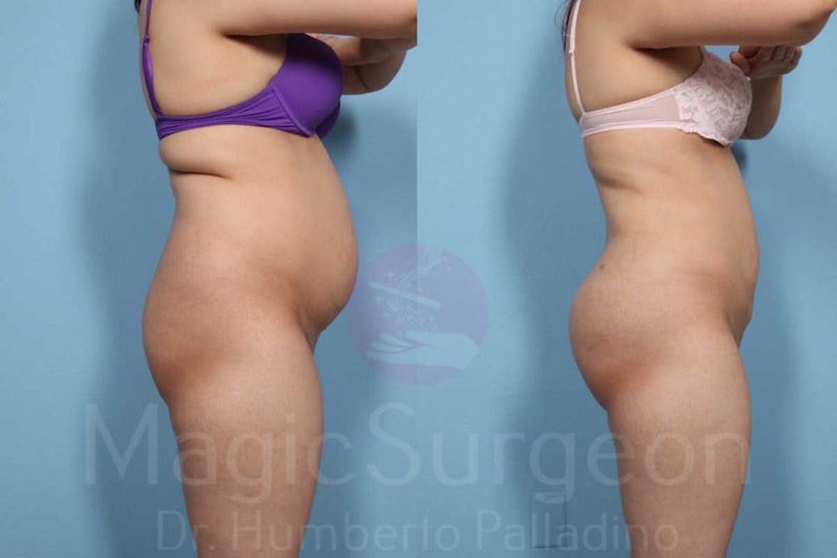 Liposuction Before & After Gallery - Patient 133182315 - Image 4