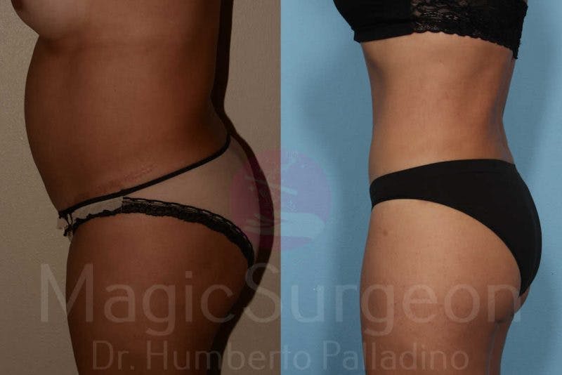 Tummy Tuck Before & After Gallery - Patient 133182316 - Image 3