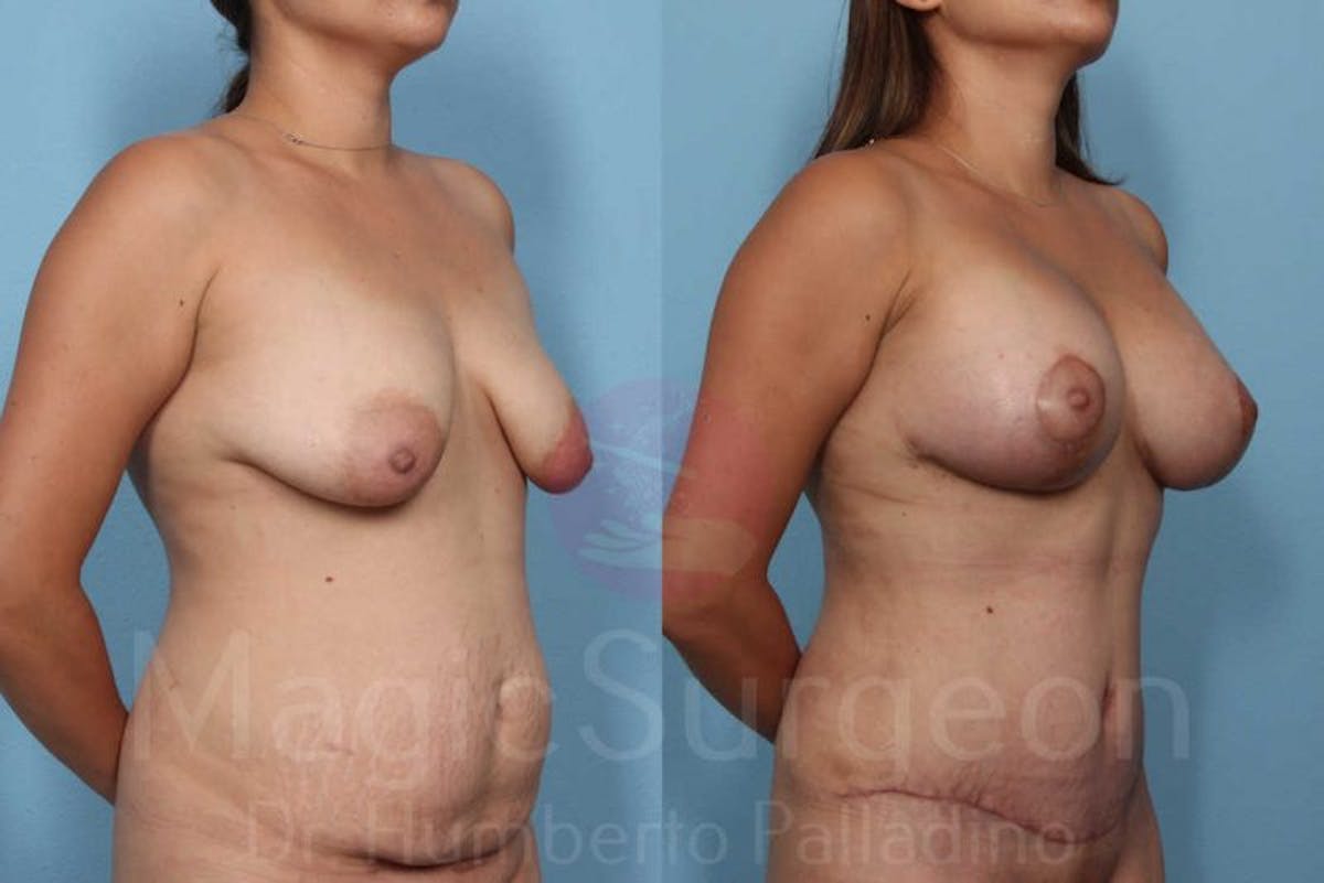 Mommy Makeover Before & After Gallery - Patient 133182317 - Image 4