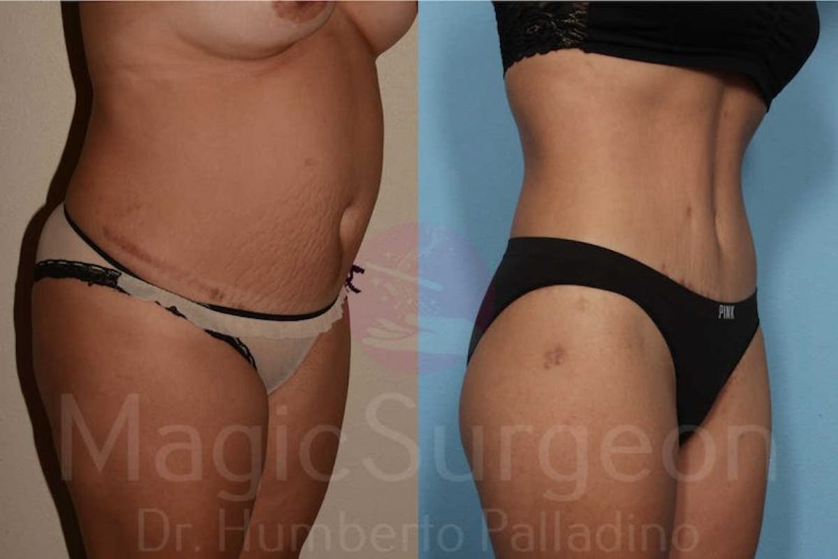 Tummy Tuck Before & After Gallery - Patient 133182316 - Image 4