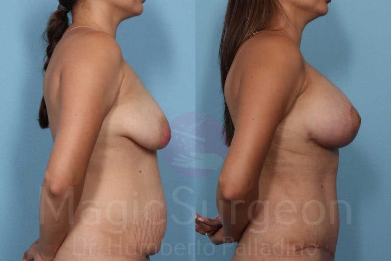 Mommy Makeover Before & After Gallery - Patient 133182317 - Image 5