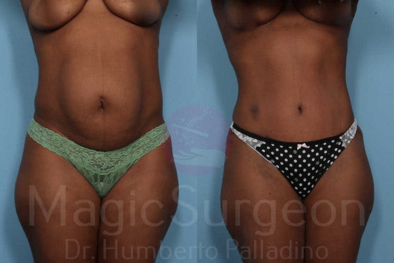 Tummy Tuck Before & After Gallery - Patient 133182321 - Image 1