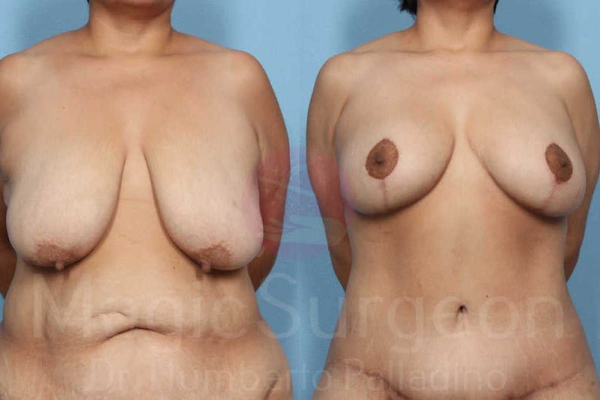 Mommy Makeover Before & After Gallery - Patient 133182320 - Image 1