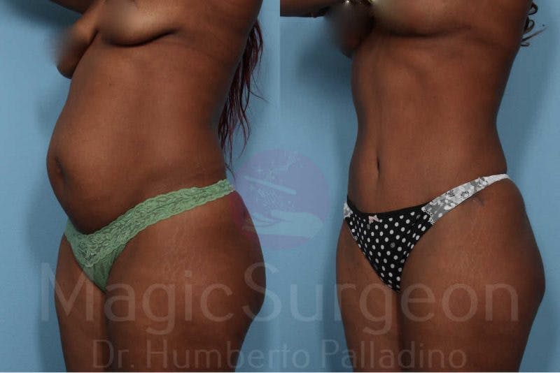 Tummy Tuck Before & After Gallery - Patient 133182321 - Image 2
