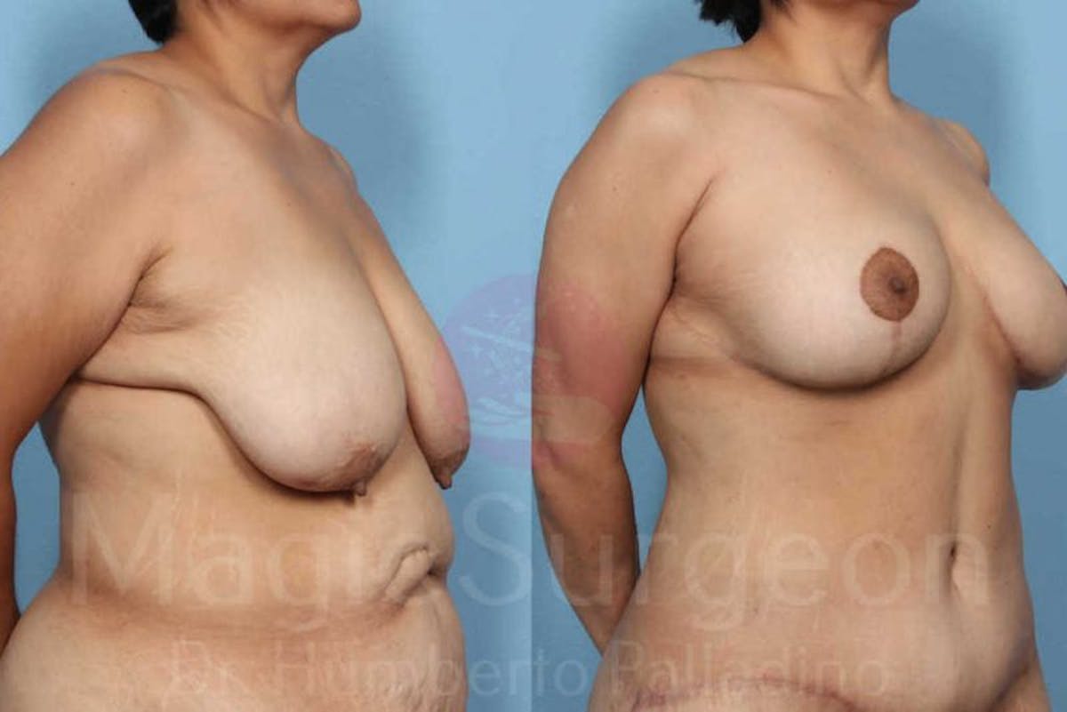 Mommy Makeover Before & After Gallery - Patient 133182320 - Image 2