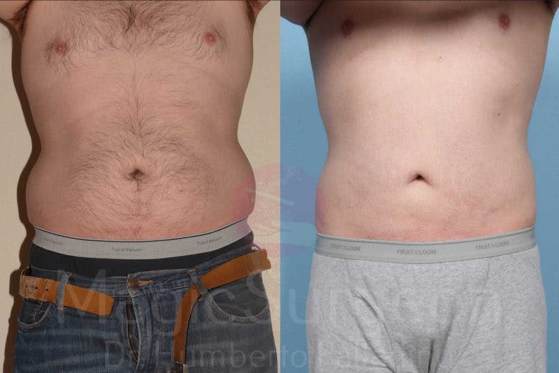 Liposuction Before & After Gallery - Patient 133182319 - Image 1