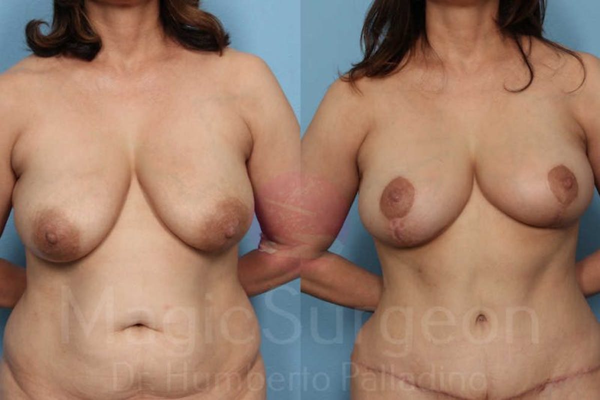 Mommy Makeover Before & After Gallery - Patient 133182320 - Image 4