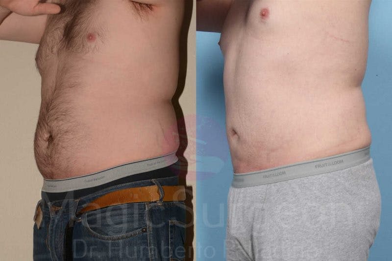 Liposuction Before & After Gallery - Patient 133182319 - Image 2