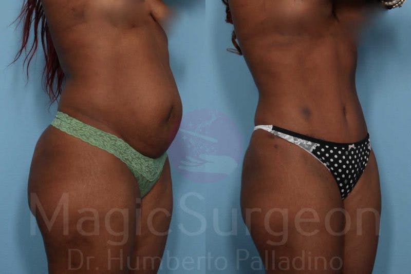 Tummy Tuck Before & After Gallery - Patient 133182321 - Image 5