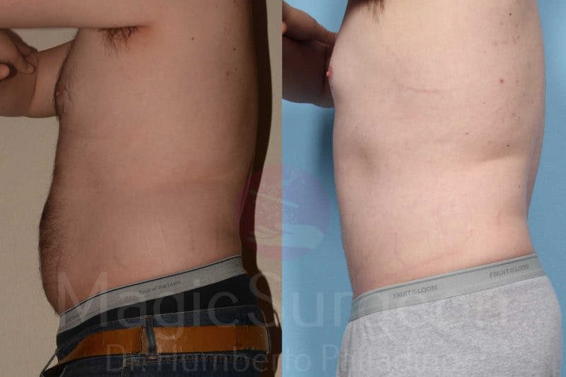 Liposuction Before & After Gallery - Patient 133182319 - Image 3