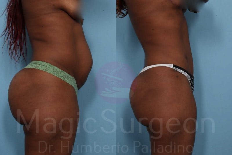 Tummy Tuck Before & After Gallery - Patient 133182321 - Image 6
