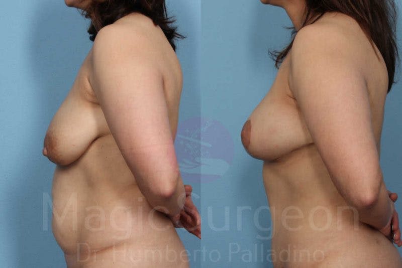 Mommy Makeover Before & After Gallery - Patient 133182320 - Image 6