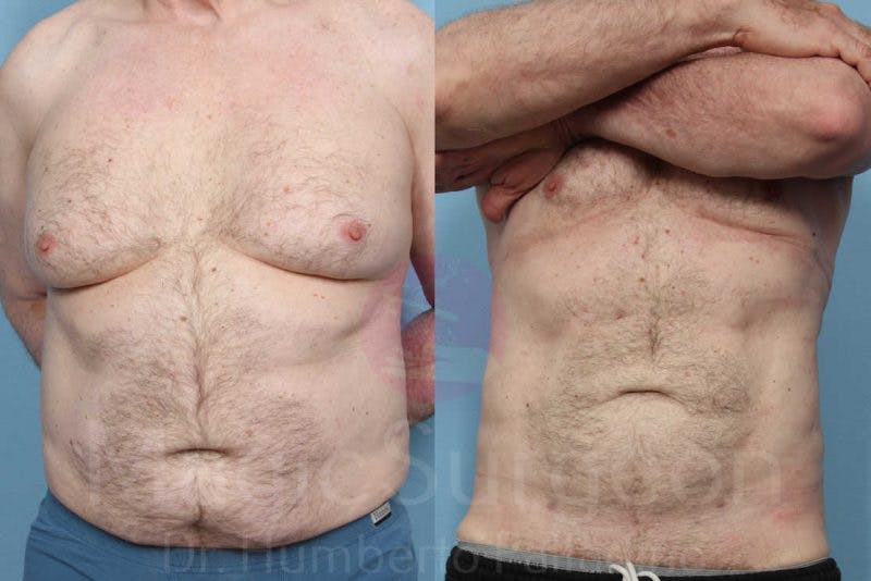 Liposuction Before & After Gallery - Patient 133182322 - Image 1